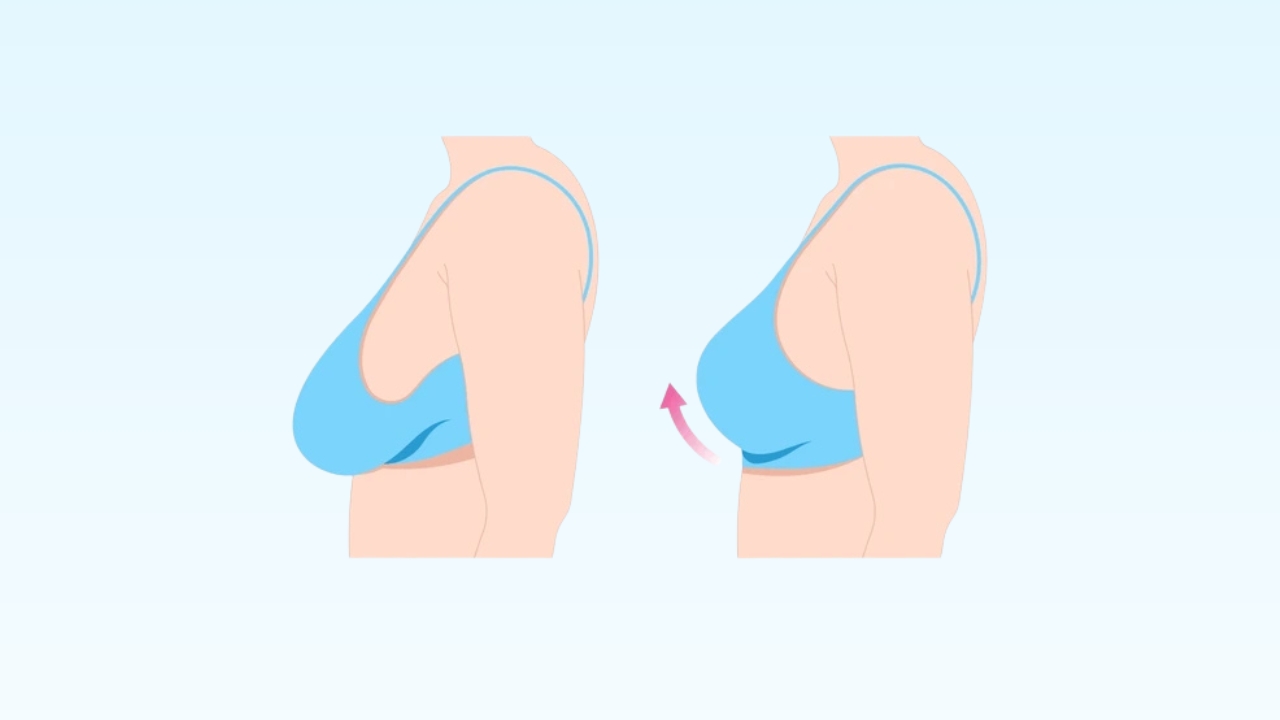 Breast Reduction Surgery Guide